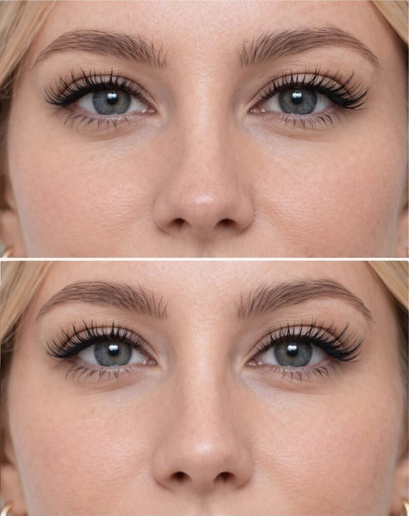 Botox Barbie/Slim Nose