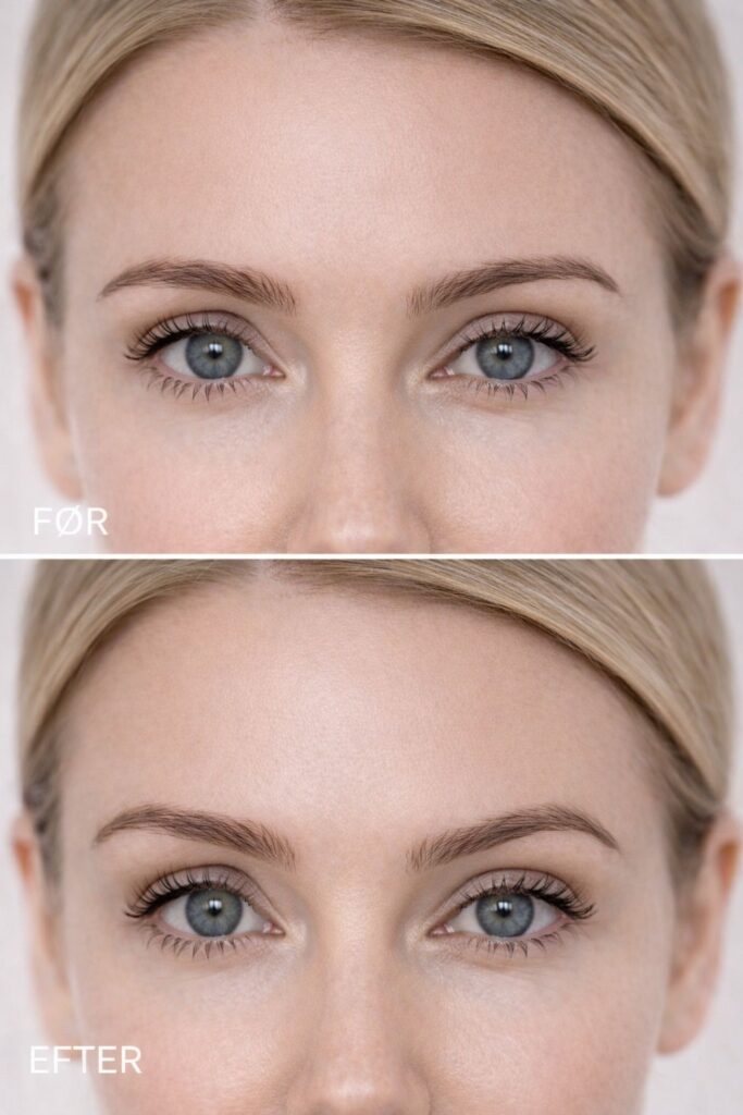 Botox Øjenbryns løft