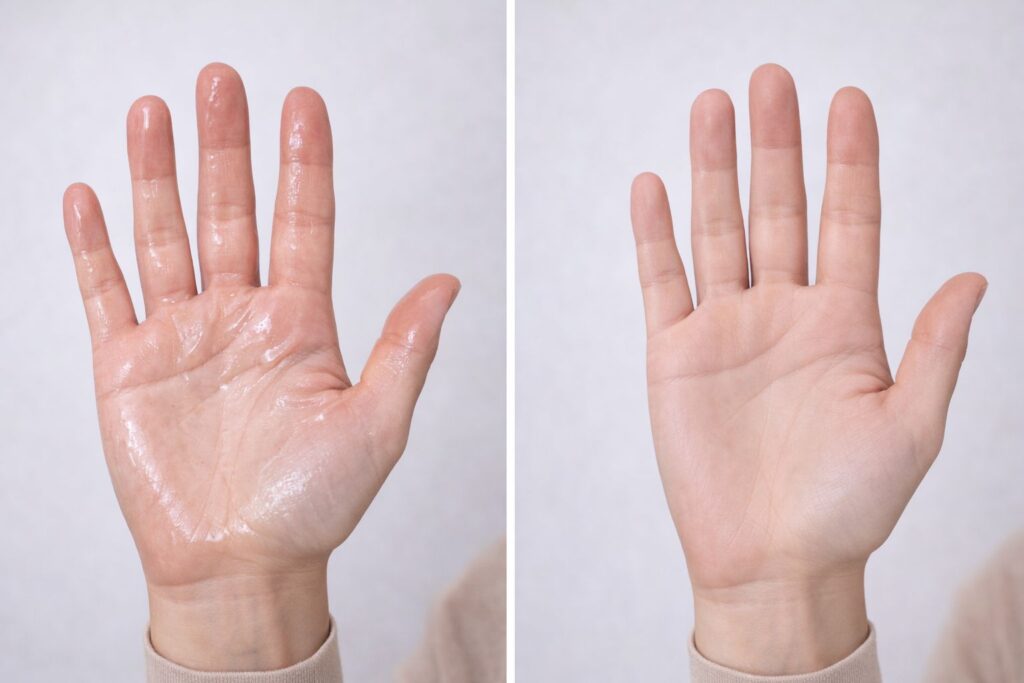 Botox svedige håndflader