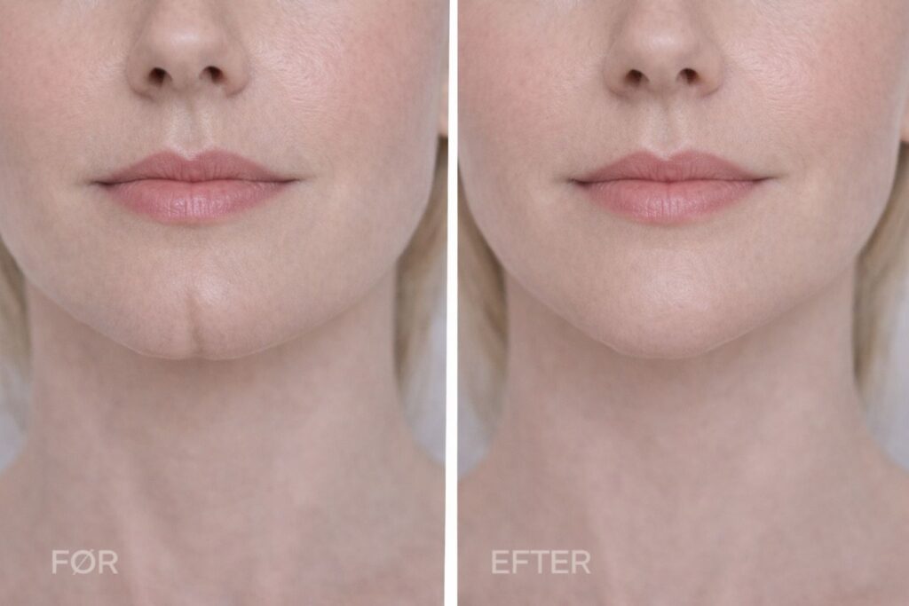 Hagefiller 0.5 ml