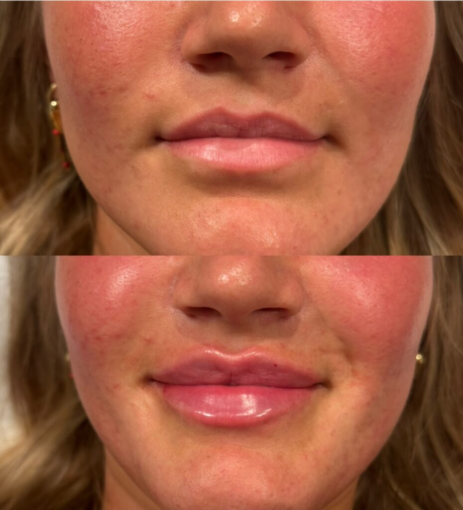 0.7 ml Fillers