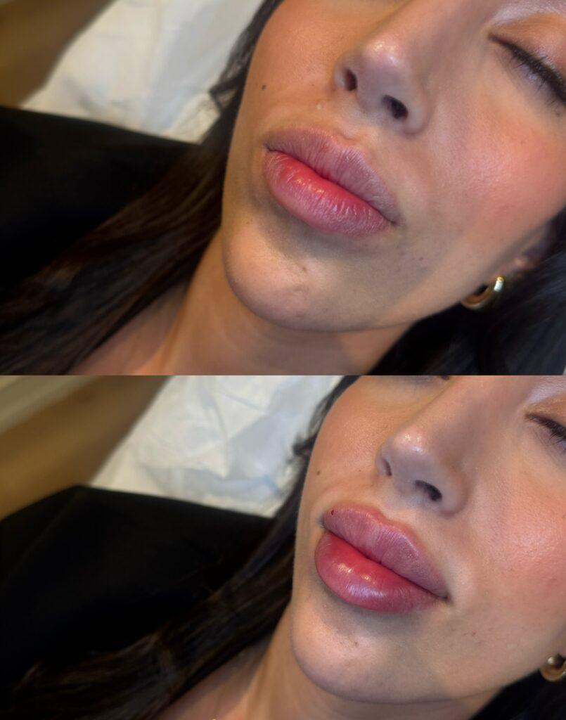 1.1 ml Fillers