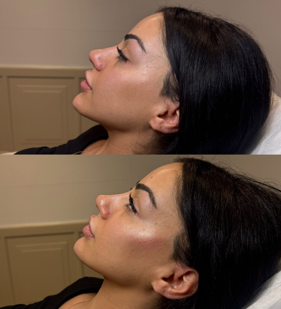 Liquid face lift – 7.7 ml
